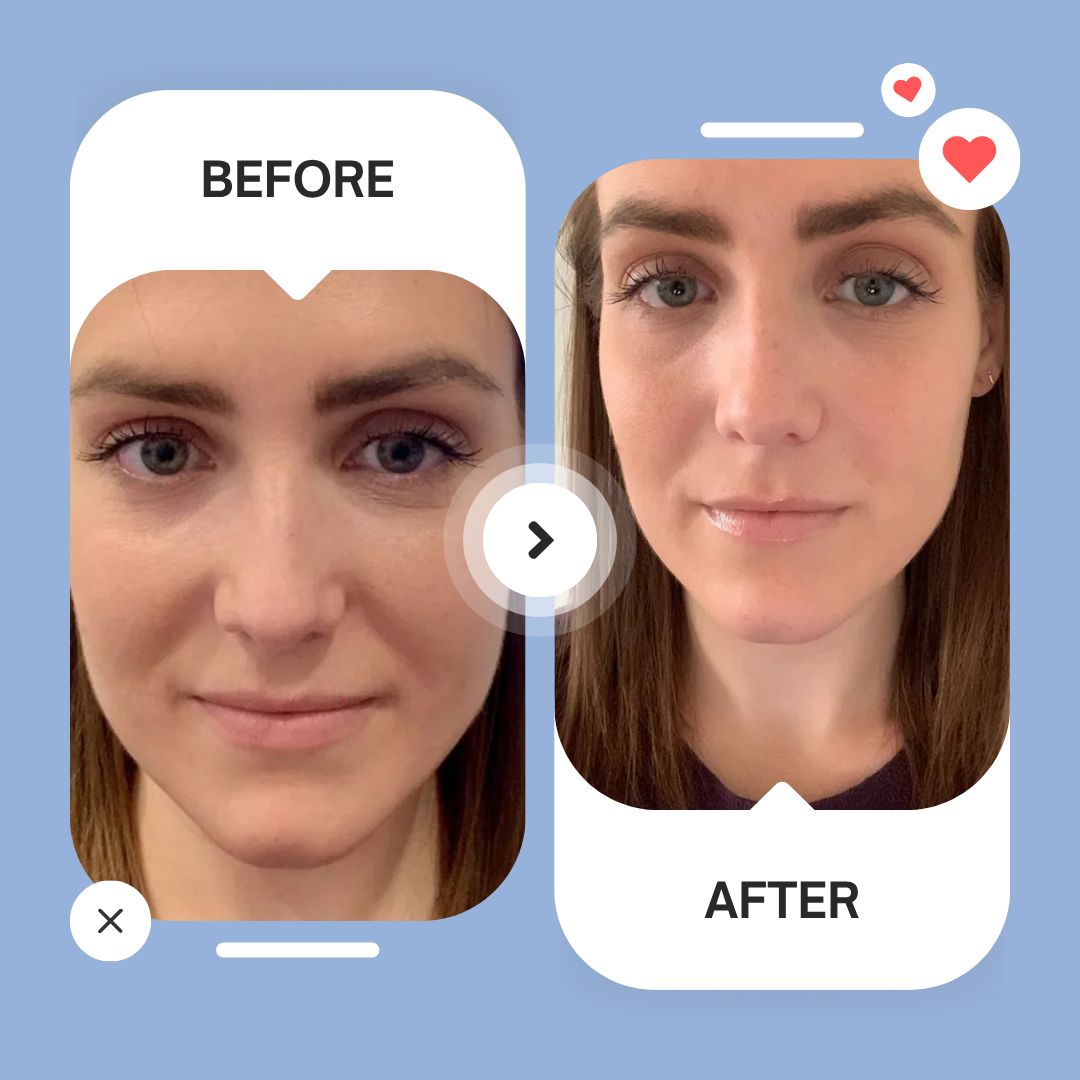 Micro-Infusion Patches