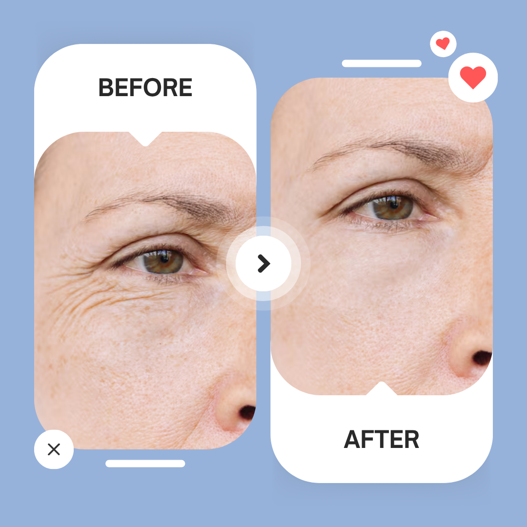 Micro-Infusion Patches