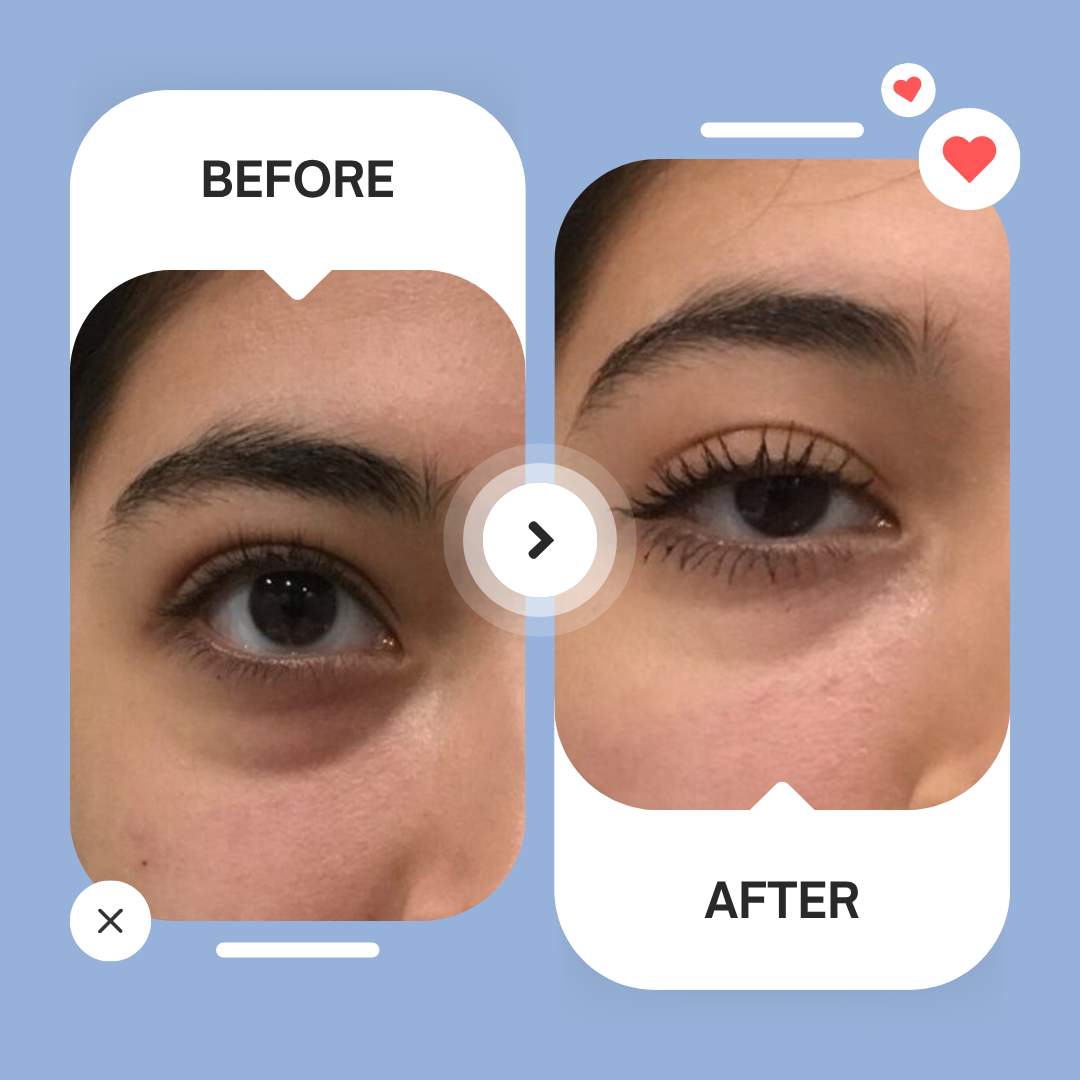 Micro-Infusion Patches